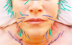 Soin du visage par acupuncture - Corée (Lifting - aculifting), Marseille - Horaires d'ouverture
